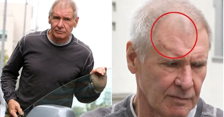 How did Harrison Ford get his scar?